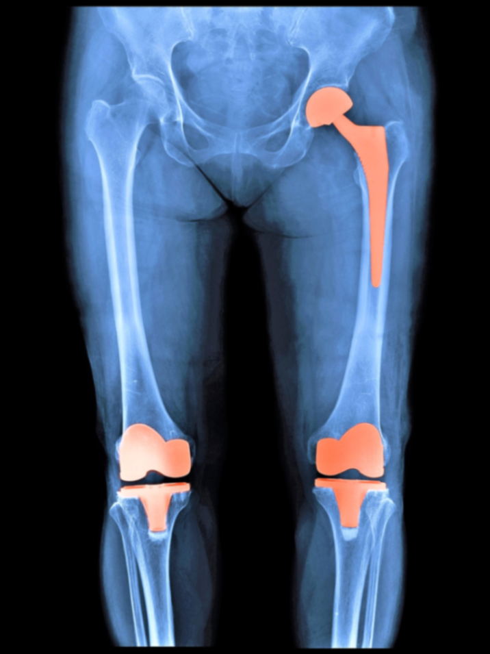 Knee & Hip Replacement Physiotherapy